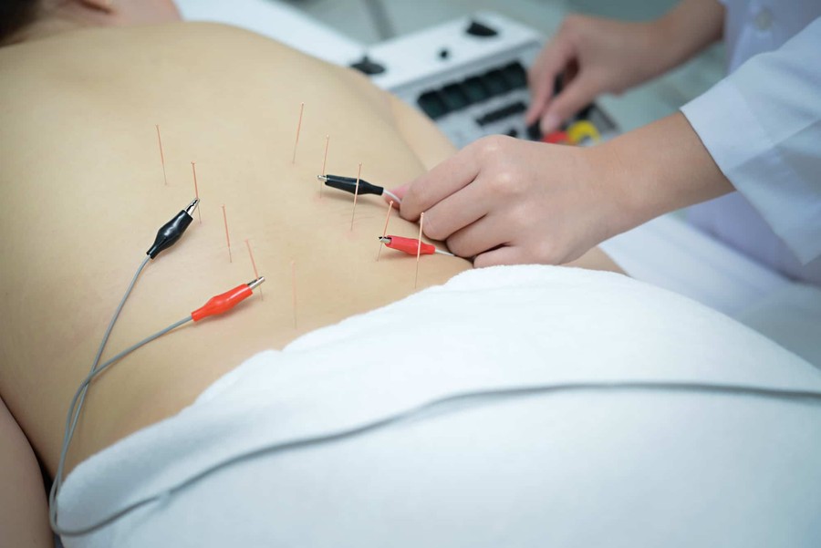 Electroacupuncture for Beginners: What Practitioners Should Know