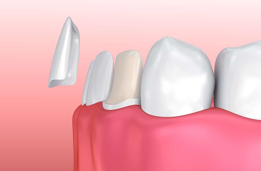Protect Your Porcelain Veneers: 6 Simple Tips for Long-Lasting Results